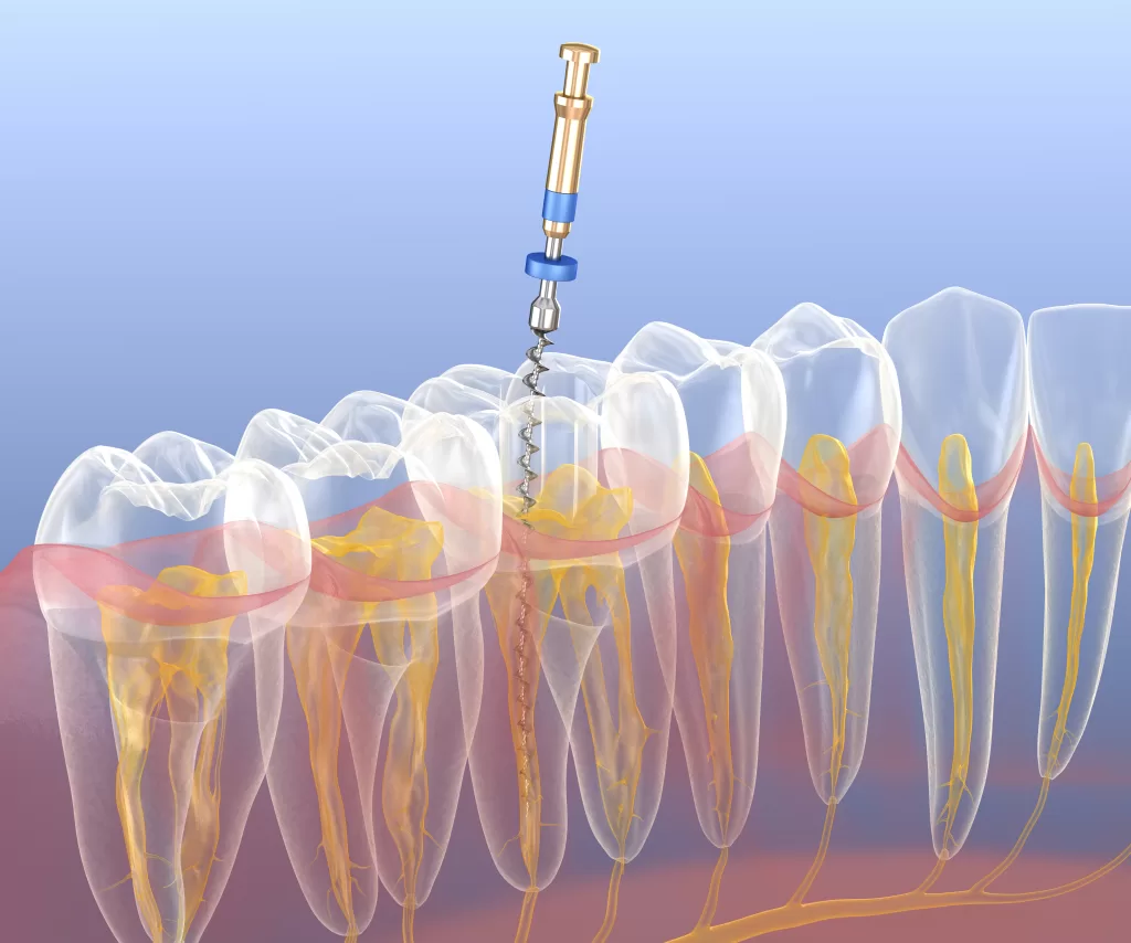 عصبکشی مجدد یا ری اندو در دندانپزشکی