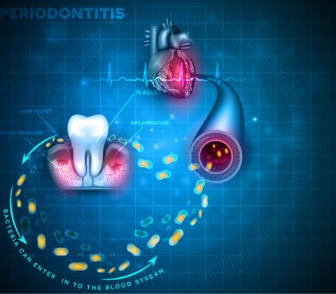 بیماری های قلبی و عروقی ناشی از پوسیدگی و خرابی دندان