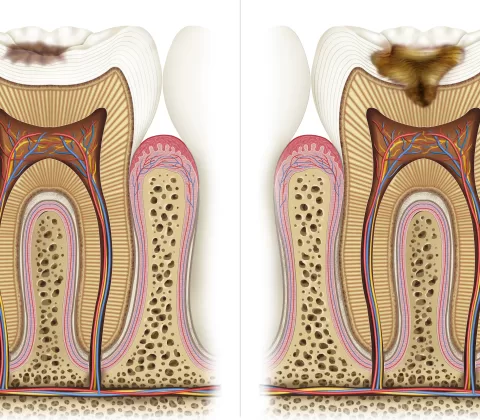 پوسیدگی و سوراخ شدن دندان