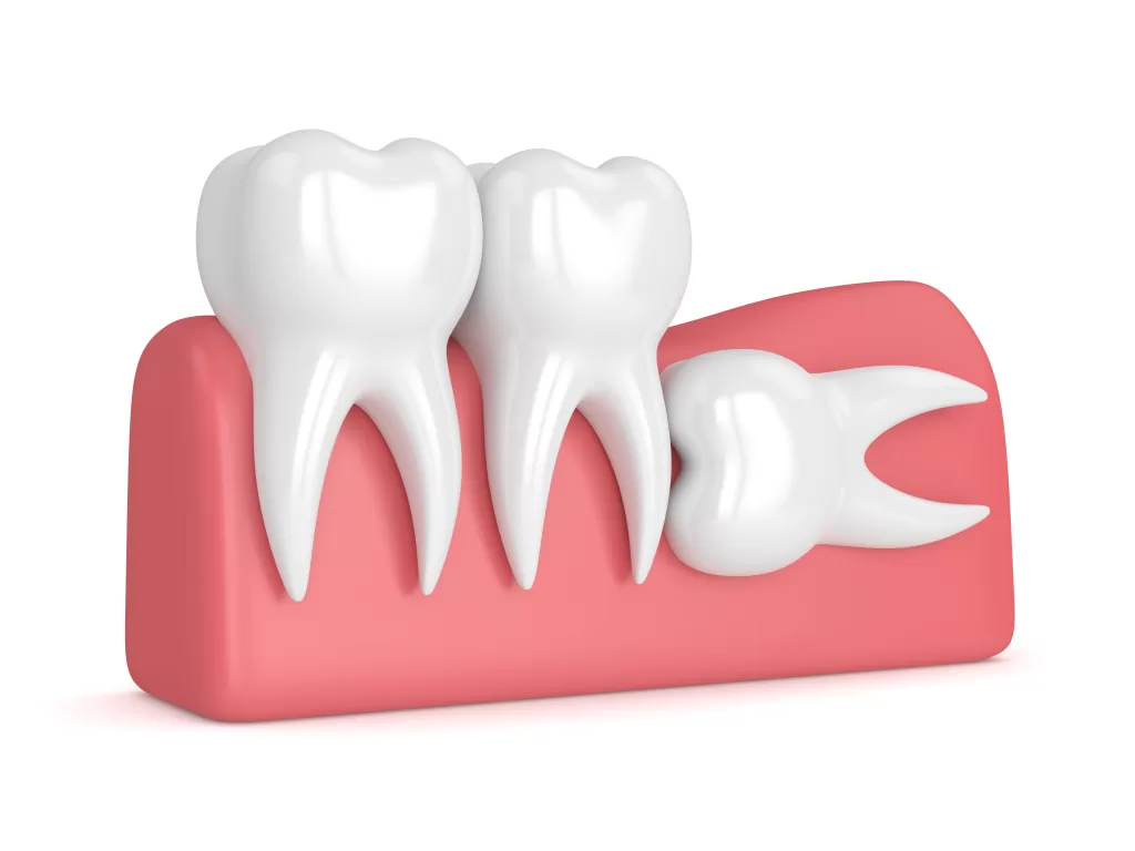 دندان عقل نهفته به دلیل جای ناکافی برای رشد در فک نهفته میشود