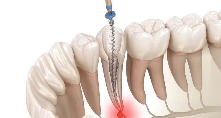 عوارض عصبکشی دندان یک