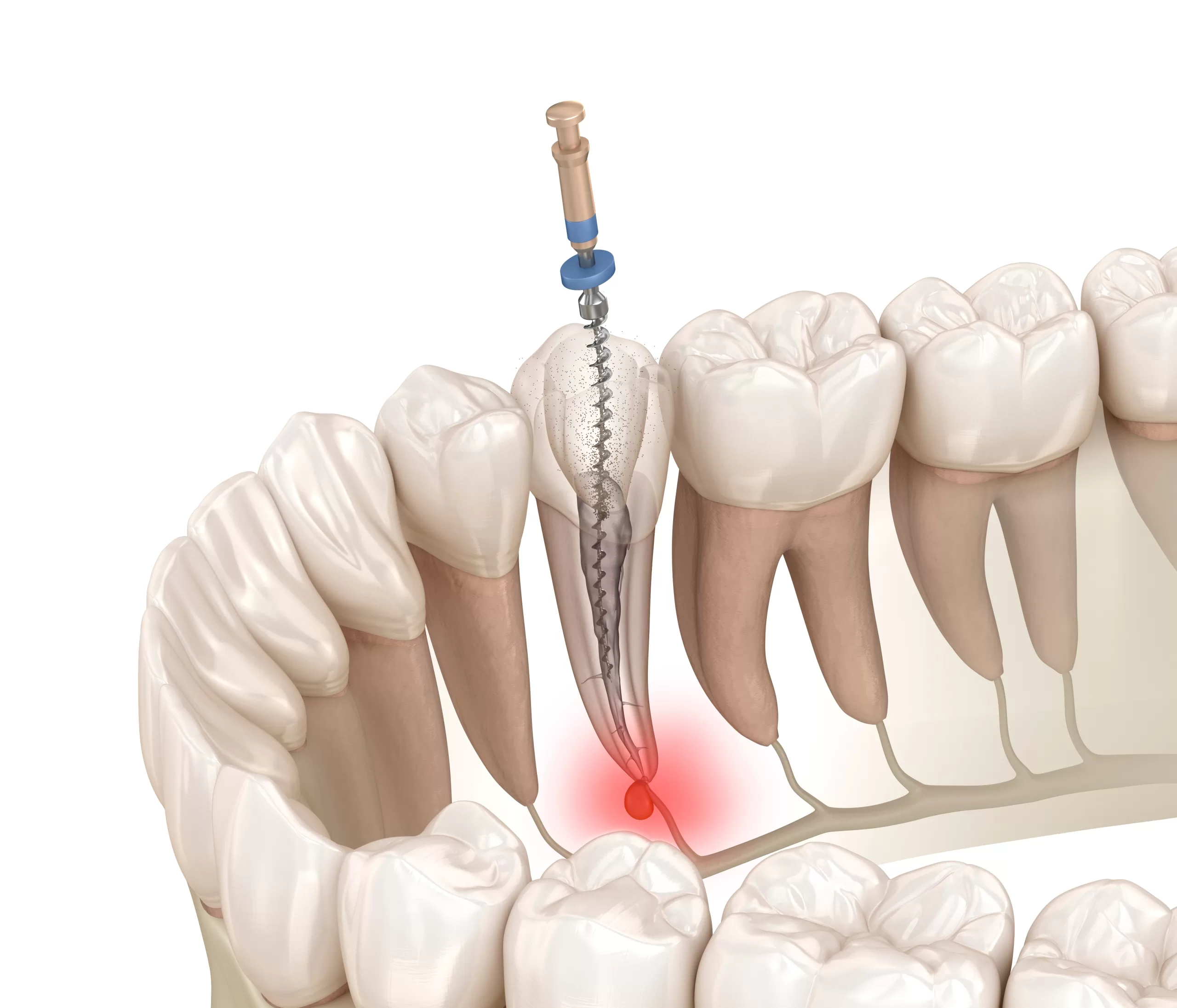 عوارض عصبکشی دندان یک