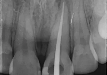 عکس حین کار عصبکشی دندان شماره یک جلویی برای تشخیص تایید انتهای کانال