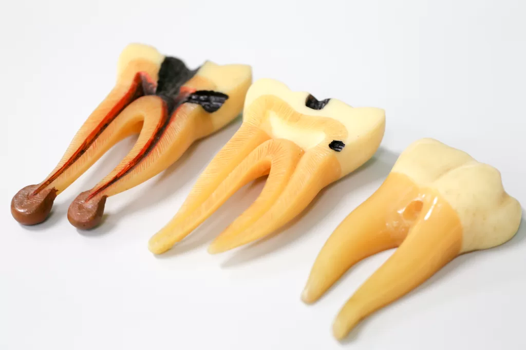 پوسیدگی و سوراخ شدن دندان و در دراز مدت و مراحل پیشرفته آسیب به پالپ و عصب دندان و دندان درد و نیاز به عصبکشی و یا کشیدن و جراحی دندان