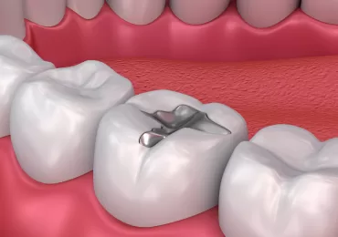 هزینه ترمیم دندان عقب از یک سطحی، دو سطحی، سه سطحی تا بیلداپ متغیر است