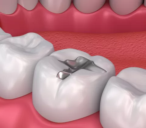 هزینه ترمیم دندان عقب از یک سطحی، دو سطحی، سه سطحی تا بیلداپ متغیر است