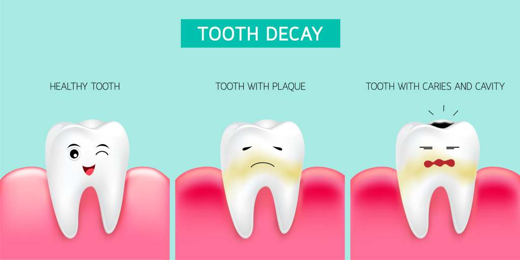 علائم پوسیدگی دندان
سوراخ شدن و یا فرورفتگی
تغییر رنگ دندان
شکستن دندان
درد دندان