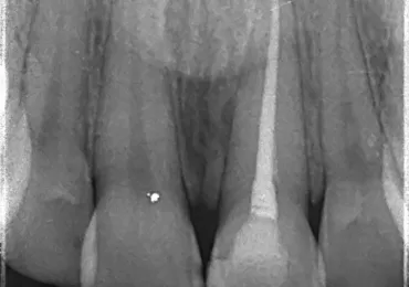 عکس پایان کار عصبکشی دندان یک جلویی
