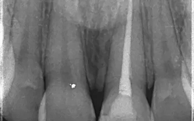 عکس پایان کار عصبکشی دندان یک جلویی