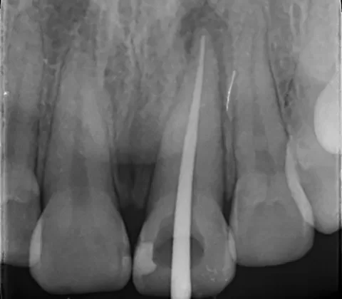 عکس حین کار عصبکشی دندان شماره یک جلویی برای تشخیص تایید انتهای کانال
