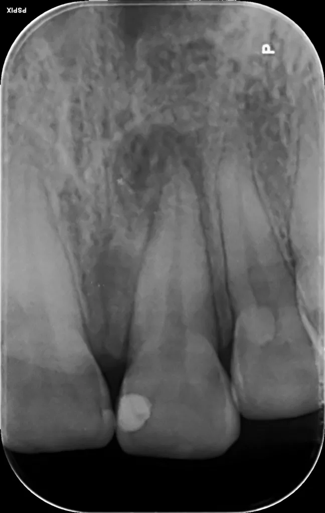 عفونت دندان پرشده نیاز به عصبکشی