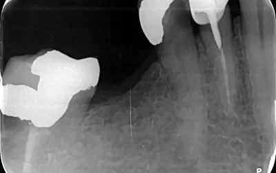 عکس دندان 5 کشیدنی