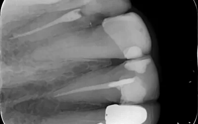 عکس پایانی از عصبکشی دندان یکم (1)