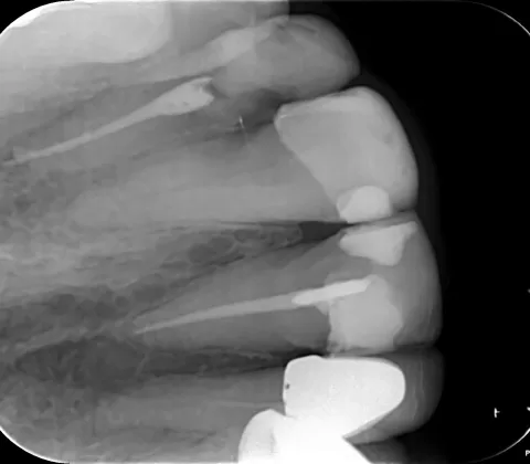 عکس پایانی از عصبکشی دندان یکم (1)
