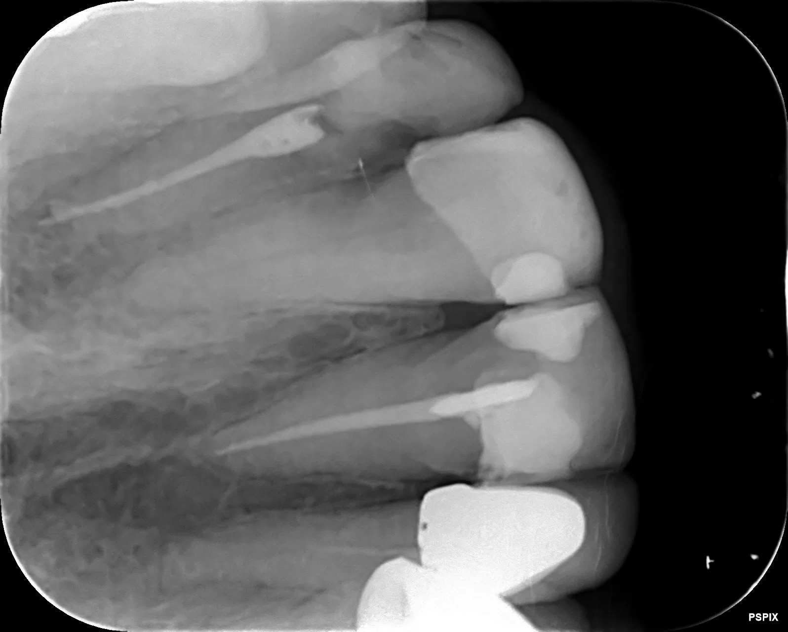 عکس پایانی از عصبکشی دندان یکم (1)