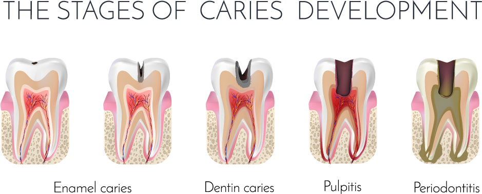 مراجل پوسیدگی دندان