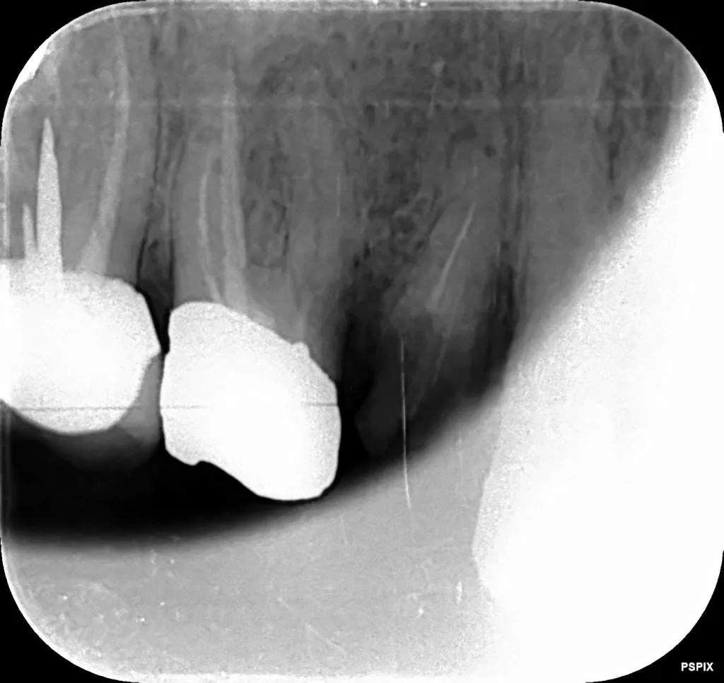 دندان 5 و 6 پوسیده که نیاز به جراحی دارد