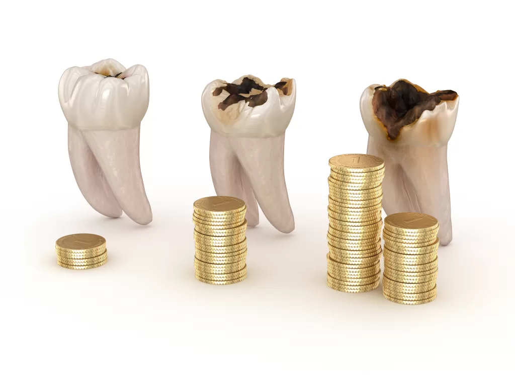 هزینه ترمیم دندان به میزان پوسیدگی، نوع دندان و ماده پرکردنی بستگی دارد