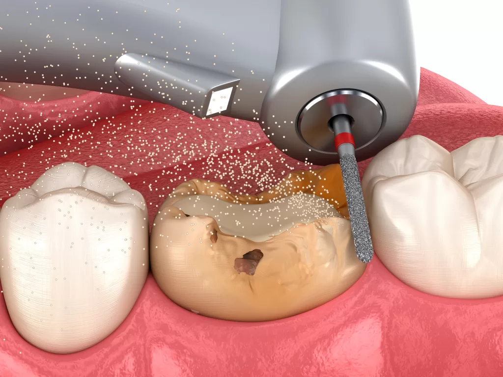 درمان پوسیدگی دندان قبل از عصبکشی