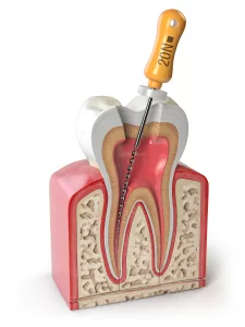 عصبکشی دندان با فایل دستی